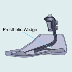 prosthetic-wedge-carbon-prosthetic-foot_medium